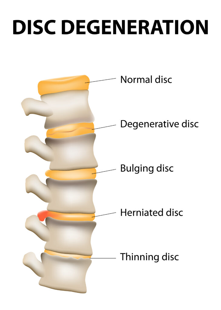 Herniated Disc - Jing Advanced Massage Training